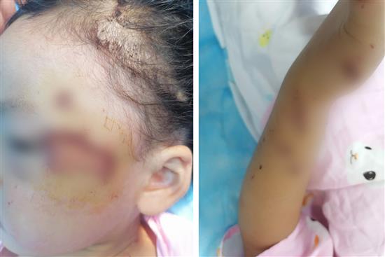 女童脸上被玻璃划伤一道三四厘米的伤口，手臂上也多处受伤。
